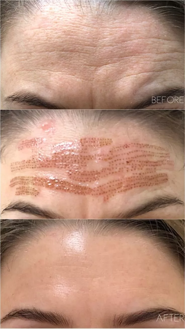 Lifting Lymphatic Drainage