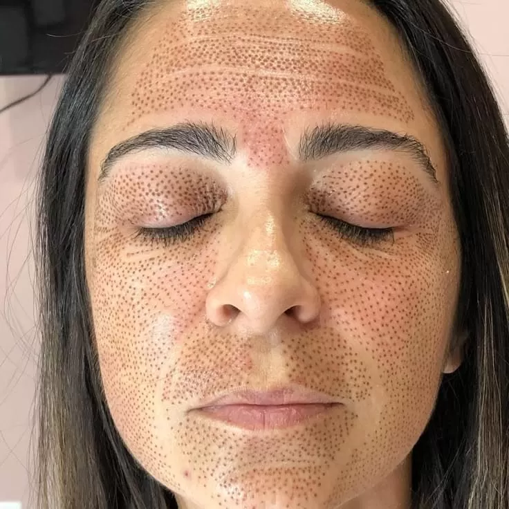 Lifting Lymphatic Drainage